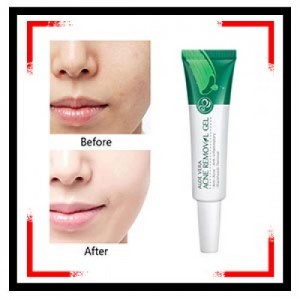 Aloe Vera Acne Removal Gel